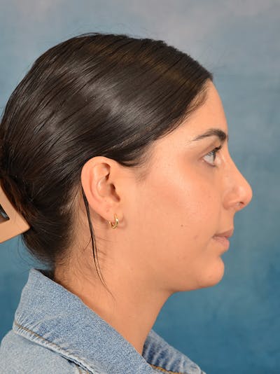 Neck Liposuction Before & After Gallery - Patient 172294946 - Image 8