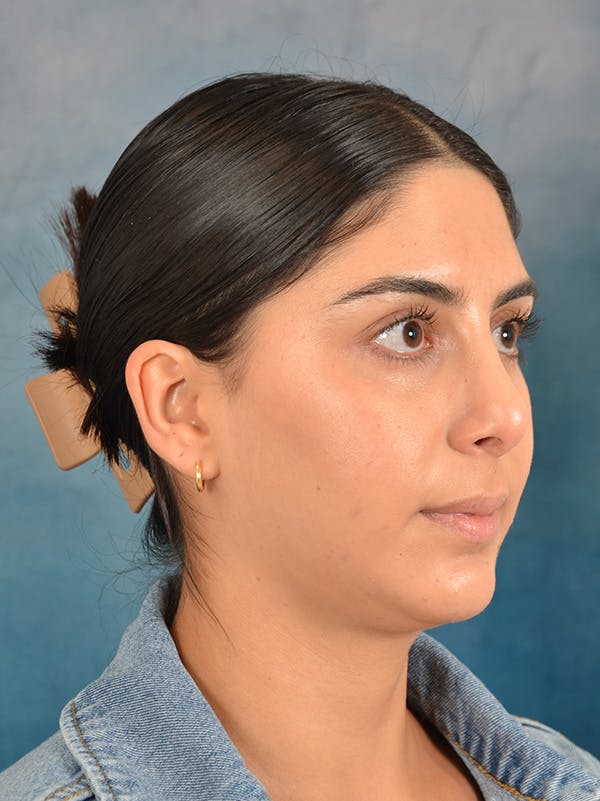 Rhinoplasty Before & After Gallery - Patient 172294930 - Image 6
