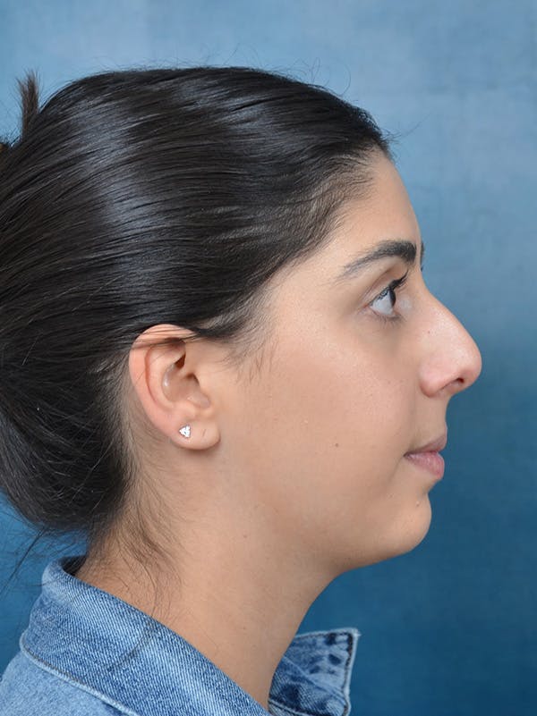 Rhinoplasty Before & After Gallery - Patient 172294930 - Image 7