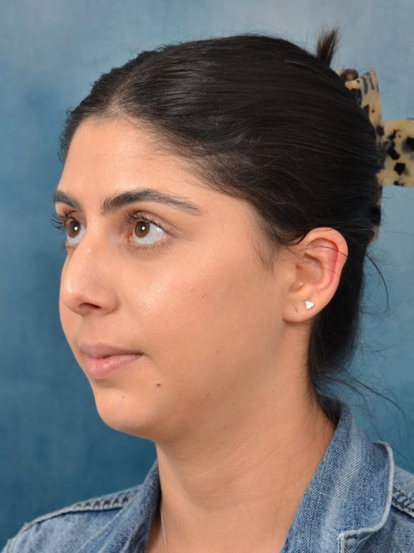 Rhinoplasty Before & After Gallery - Patient 172294930 - Image 9