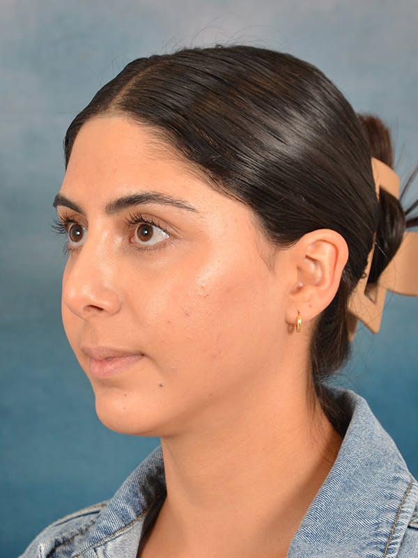 Rhinoplasty Before & After Gallery - Patient 172294930 - Image 10