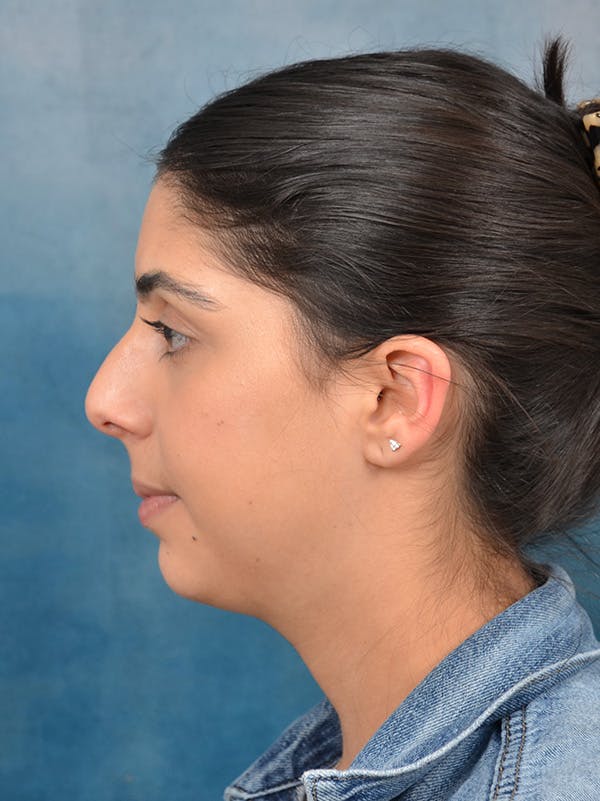 Neck Liposuction Before & After Gallery - Patient 172294946 - Image 3