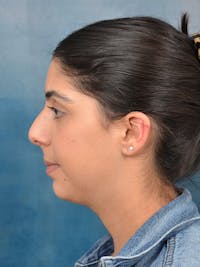 Rhinoplasty Before & After Gallery - Patient 172294930 - Image 1