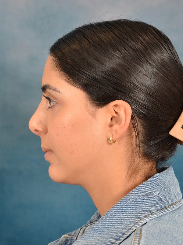 Neck Liposuction Before & After Gallery - Patient 172294946 - Image 4