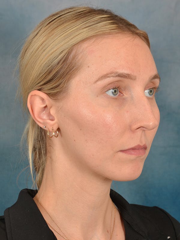 Rhinoplasty Before & After Gallery - Patient 186182857 - Image 5