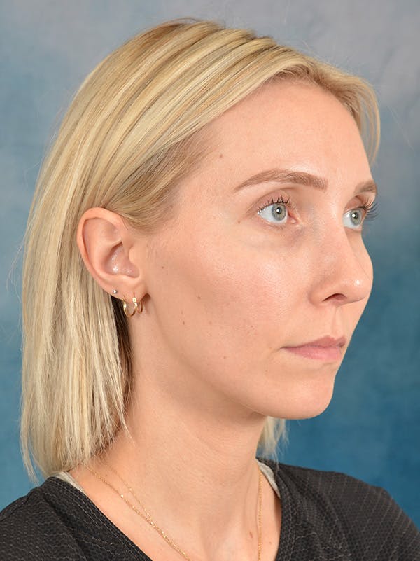 Rhinoplasty Before & After Gallery - Patient 158444426 - Image 6