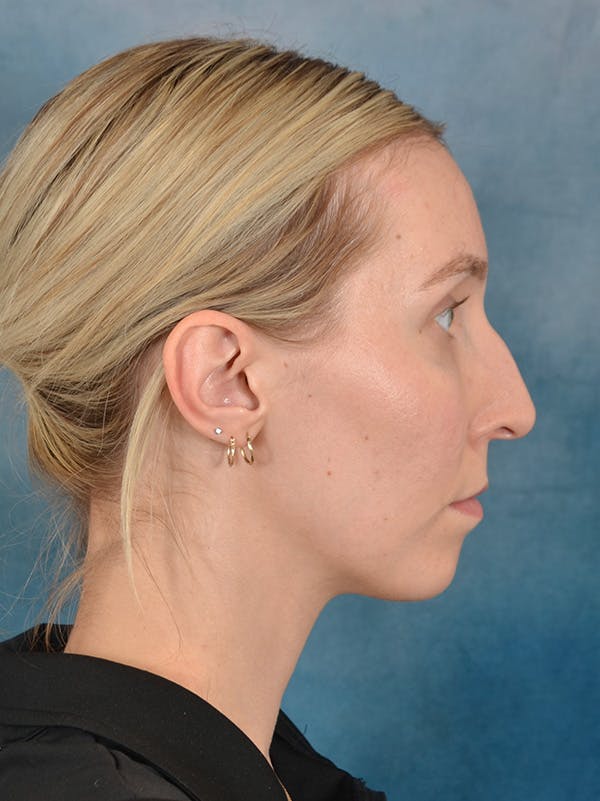 Rhinoplasty Before & After Gallery - Patient 186182857 - Image 7
