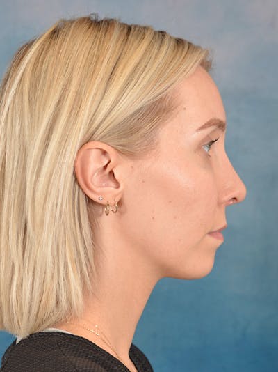 Rhinoplasty Before & After Gallery - Patient 186182857 - Image 8