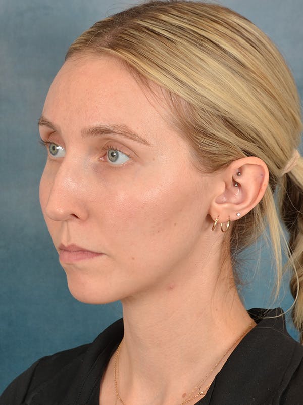 Rhinoplasty Before & After Gallery - Patient 186182857 - Image 9