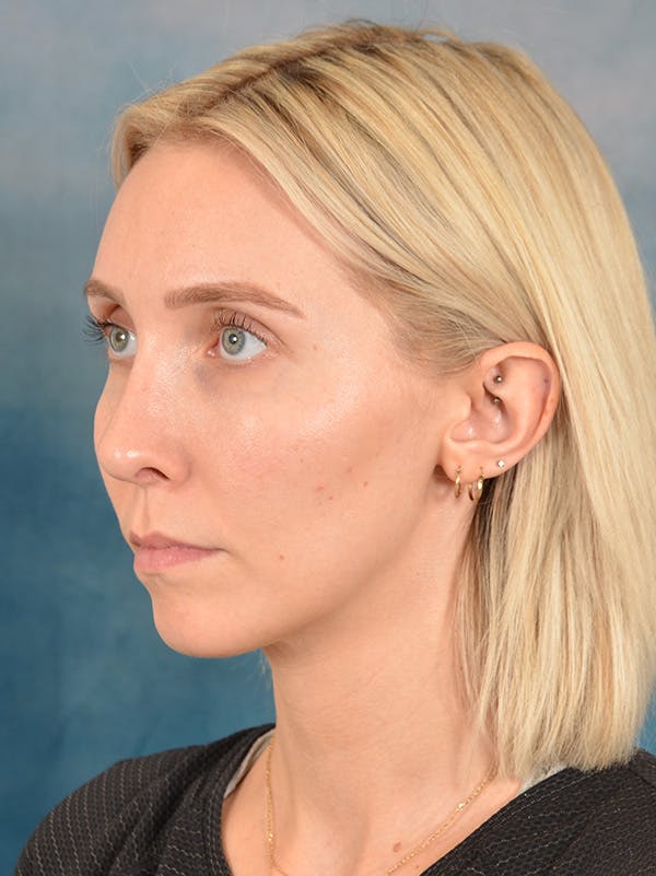 Rhinoplasty Before & After Gallery - Patient 186182857 - Image 10