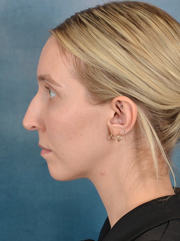 Rhinoplasty Before & After Gallery - Patient 158444426 - Image 1