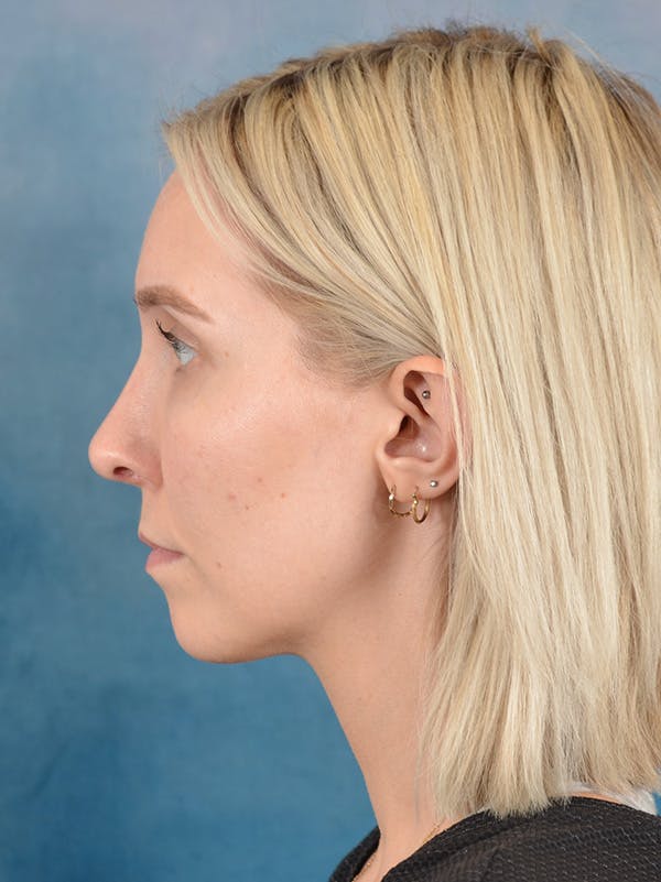 Rhinoplasty Before & After Gallery - Patient 186182857 - Image 2
