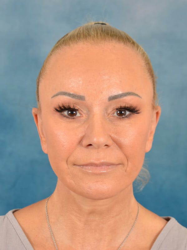 Deep Plane Facelift Before & After Gallery - Patient 176431928 - Image 4