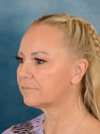 Deep Plane Facelift Before & After Gallery - Patient 176431928 - Image 1