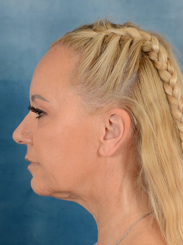 Deep Plane Facelift Before & After Gallery - Patient 176431928 - Image 9