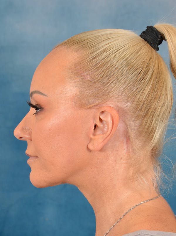 Deep Plane Facelift Before & After Gallery - Patient 176431928 - Image 10