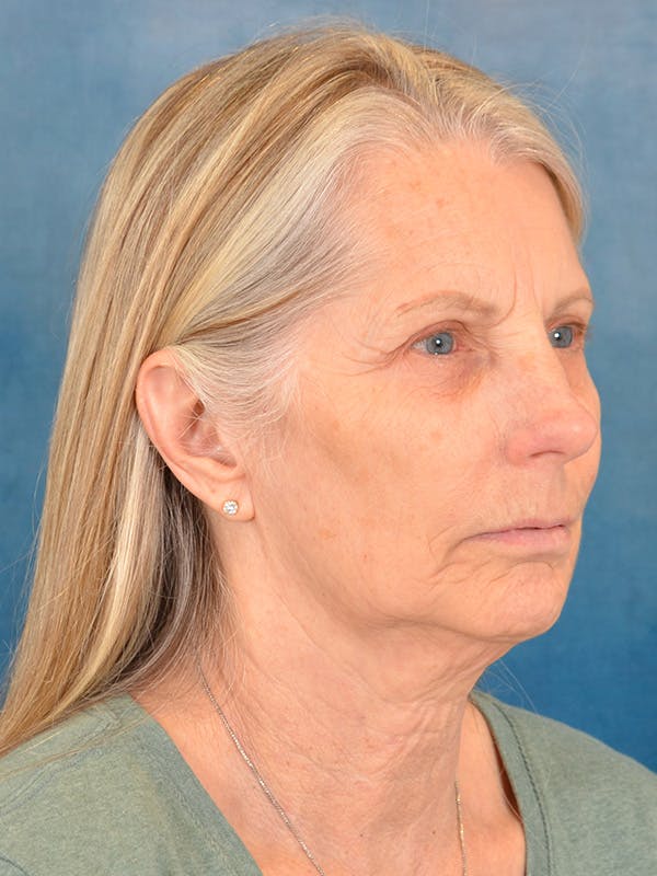 Deep Plane Facelift Before & After Gallery - Patient 391774 - Image 3