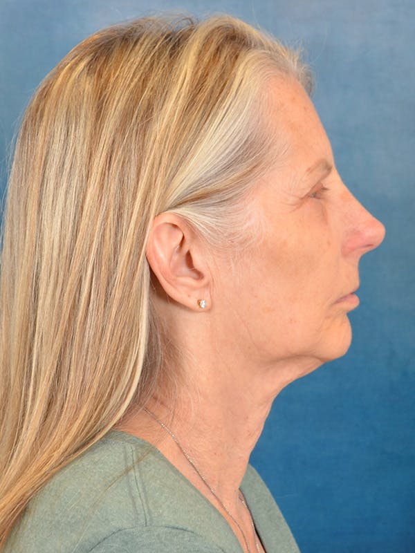 Deep Plane Facelift Before & After Gallery - Patient 391774 - Image 5