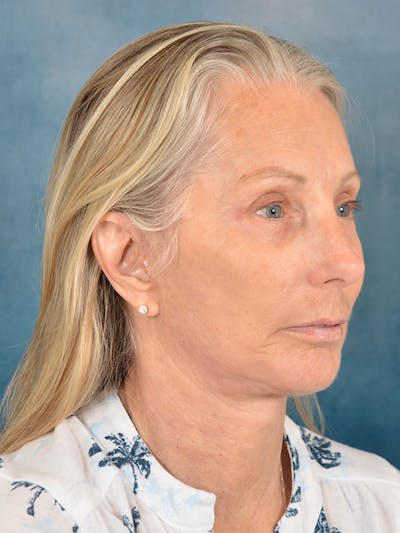 Deep Plane Facelift Before & After Gallery - Patient 391774 - Image 4