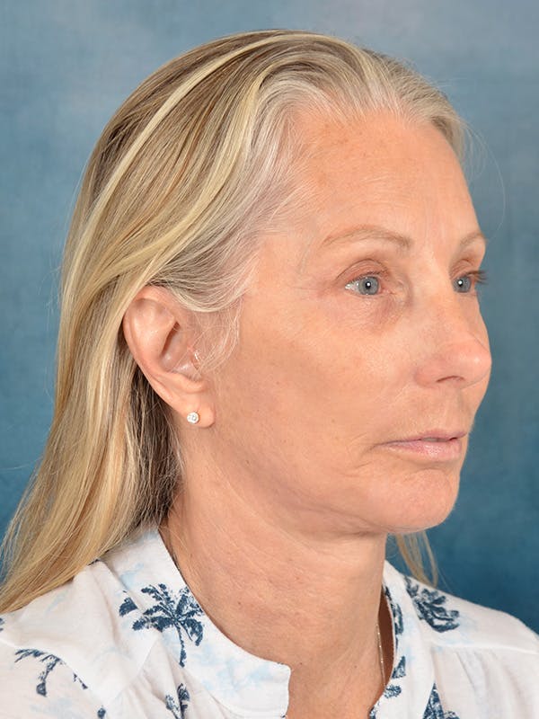 Deep Plane Facelift Before & After Gallery - Patient 391774 - Image 4