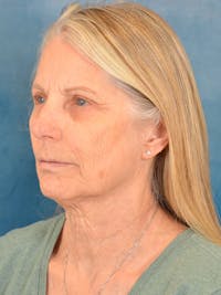 Deep Plane Facelift Before & After Gallery - Patient 391774 - Image 1
