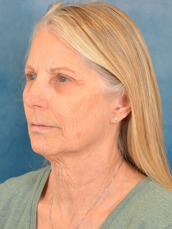 Deep Plane Facelift Before & After Gallery - Patient 158443157 - Image 1