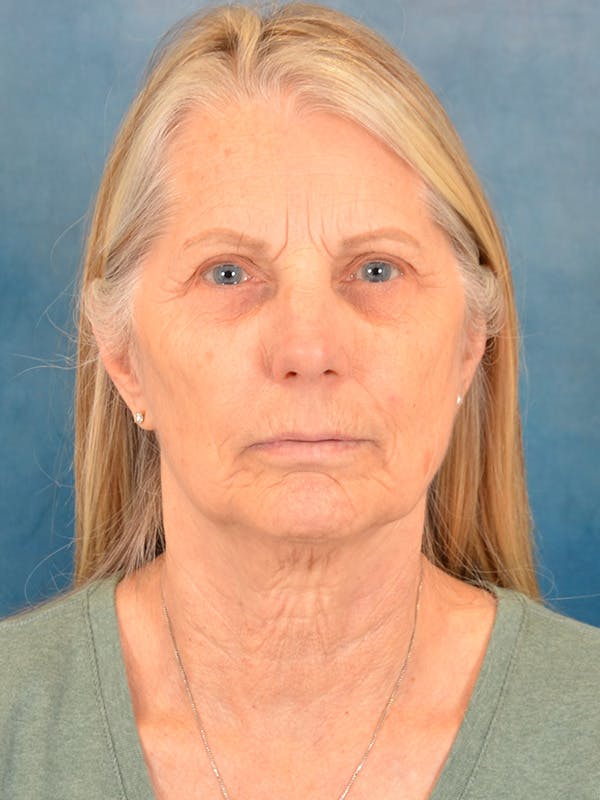 Deep Plane Facelift Before & After Gallery - Patient 391774 - Image 7