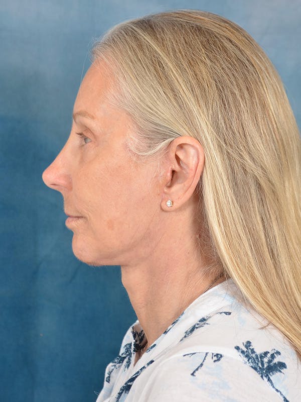 Deep Plane Facelift Before & After Gallery - Patient 391774 - Image 10