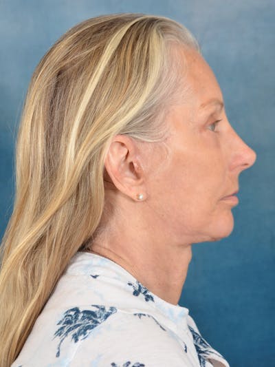 Deep Plane Facelift Before & After Gallery - Patient 391774 - Image 6