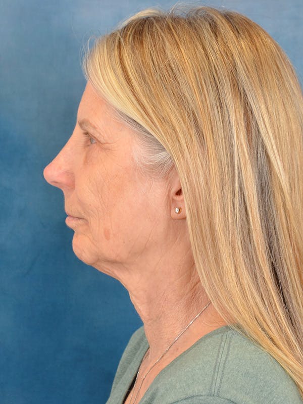 Deep Plane Facelift Before & After Gallery - Patient 391774 - Image 9