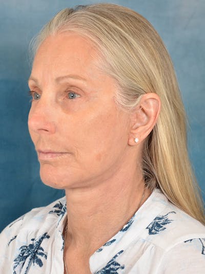 Deep Plane Facelift Before & After Gallery - Patient 391774 - Image 2