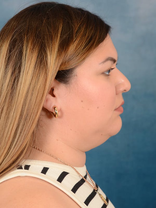Deep Neck Lift Before & After Gallery - Patient 158444769 - Image 7