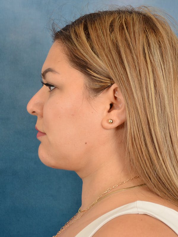 Deep Neck Lift Before & After Gallery - Patient 158444769 - Image 10