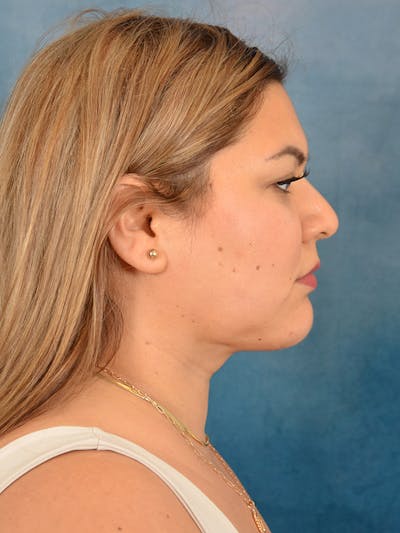 Deep Neck Lift Before & After Gallery - Patient 158444769 - Image 8