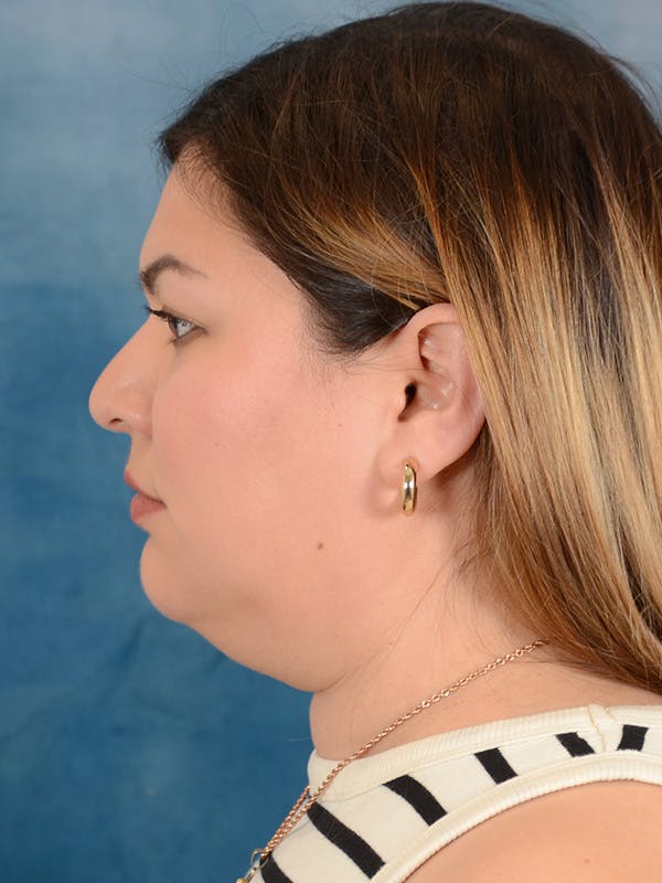 Deep Neck Lift Before & After Gallery - Patient 158444769 - Image 9