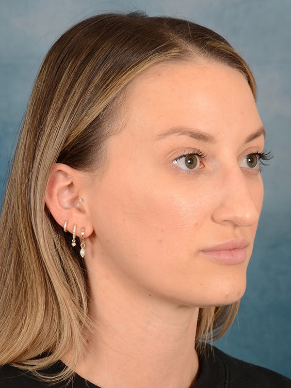 Rhinoplasty Before & After Gallery - Patient 186182905 - Image 5
