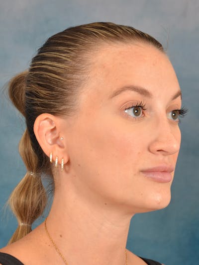 Rhinoplasty Before & After Gallery - Patient 186182905 - Image 6