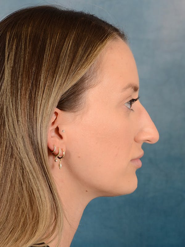 Rhinoplasty Before & After Gallery - Patient 186182905 - Image 7
