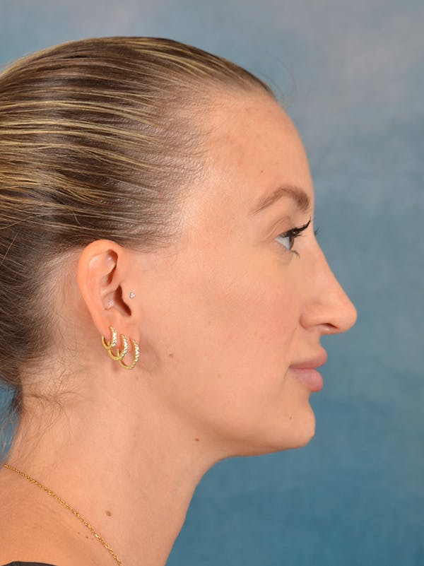 Rhinoplasty Before & After Gallery - Patient 186182905 - Image 8