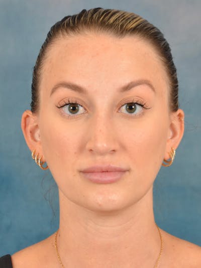 Rhinoplasty Before & After Gallery - Patient 186182905 - Image 10