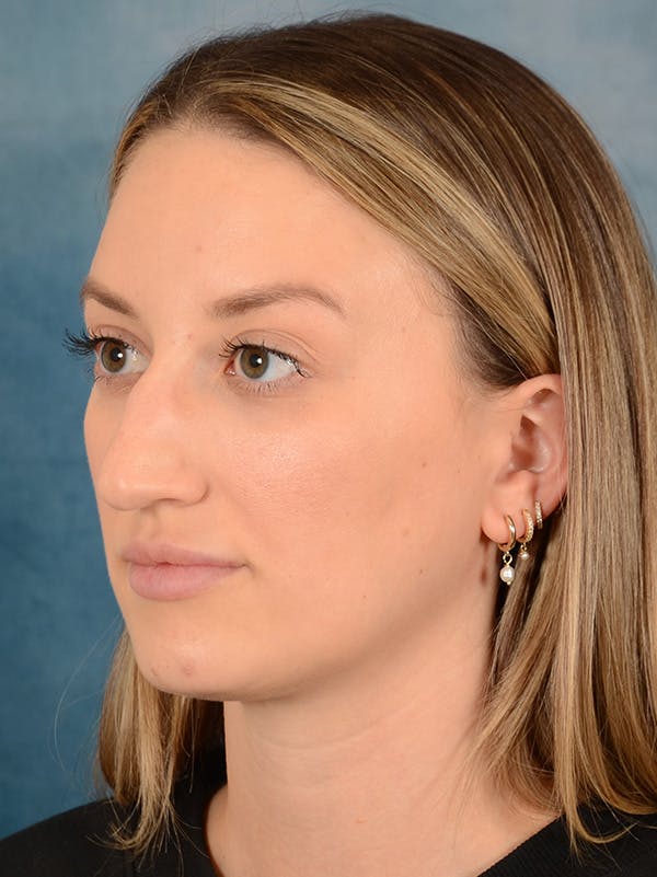 Rhinoplasty Before & After Gallery - Patient 186182905 - Image 3