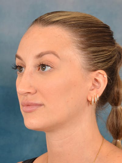 Rhinoplasty Before & After Gallery - Patient 186182905 - Image 4