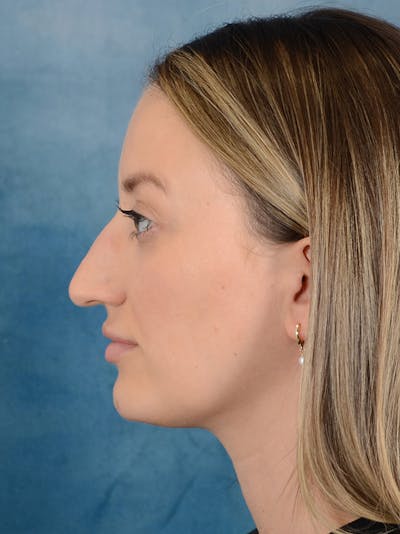 Rhinoplasty Before & After Gallery - Patient 186182905 - Image 1