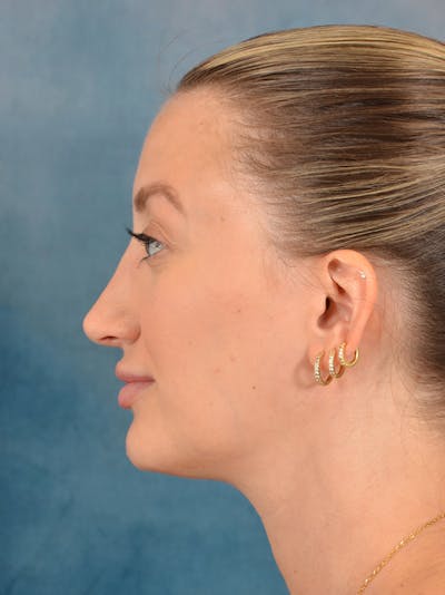 Rhinoplasty Before & After Gallery - Patient 186182905 - Image 2