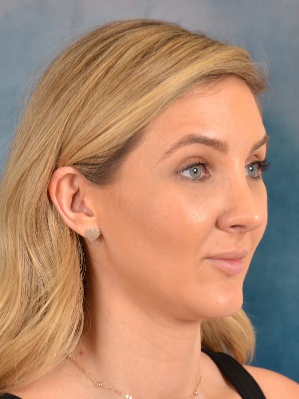 Rhinoplasty Before & After Gallery - Patient 186182966 - Image 6