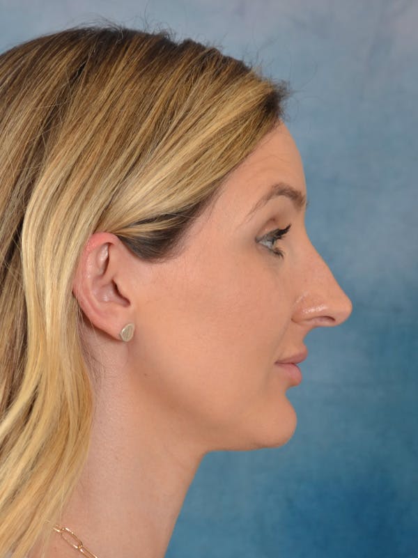 Rhinoplasty Before & After Gallery - Patient 186182966 - Image 7