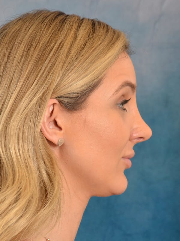 Rhinoplasty Before & After Gallery - Patient 186182966 - Image 8