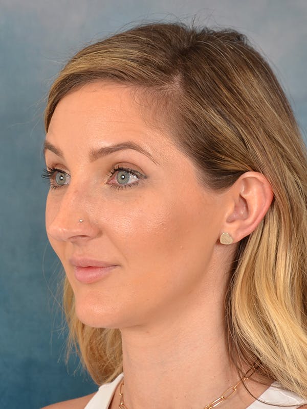 Rhinoplasty Before & After Gallery - Patient 186182966 - Image 3
