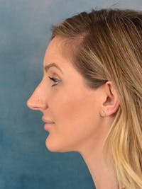 Rhinoplasty Before & After Gallery - Patient 186182966 - Image 1