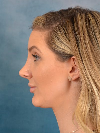 Rhinoplasty Before & After Gallery - Patient 186182966 - Image 2